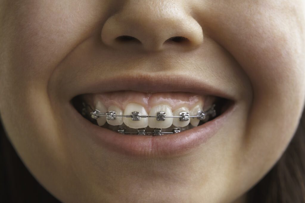 Two Phase Orthodontic Treatment in Mt Airy, Maryland